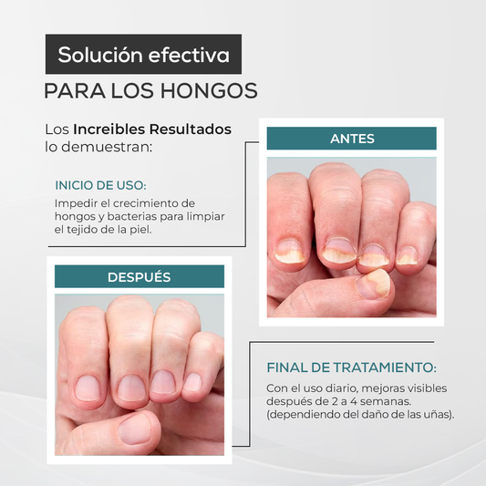 My Finger Solution – Tratamiento Completo Antihongos